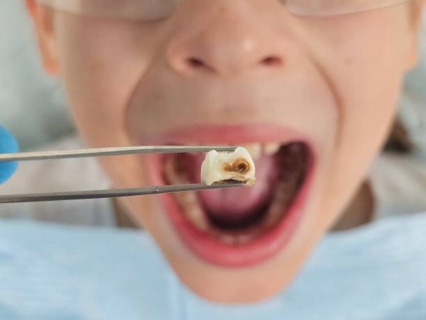 Best Emergency Dentist for Lost Fillings or Crowns in Hope Mills, NC